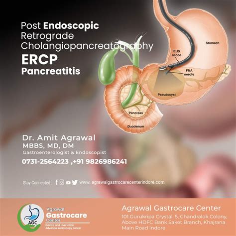 4, Y84. . Post ercp pancreatitis icd10